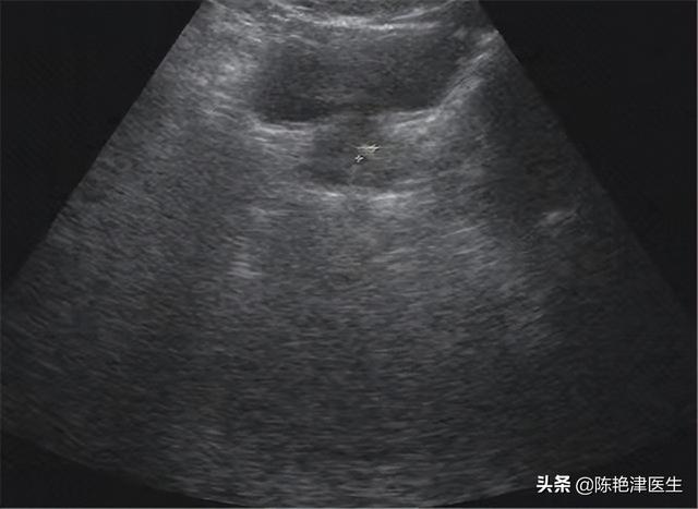 肿瘤ca125检查多少钱（ca125检查多少钱一次）